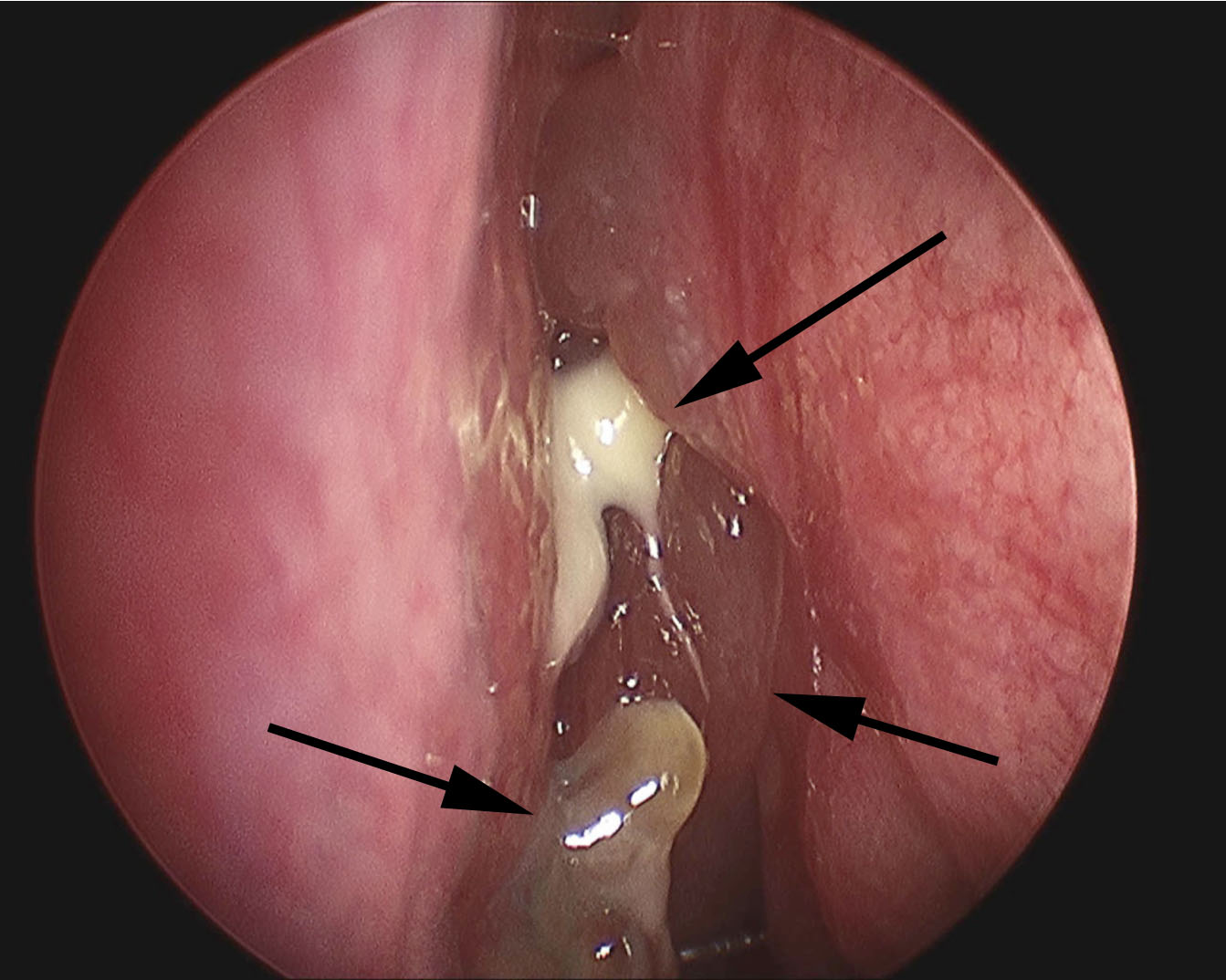 sinus congestion blood